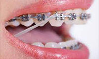 elastics (rubber bands)