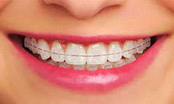 clear braces